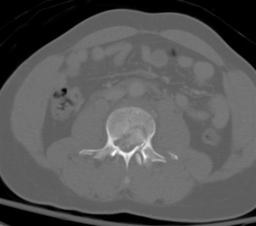 Chance Fracture (flexion-distraction injury) - Spine - Orthobullets